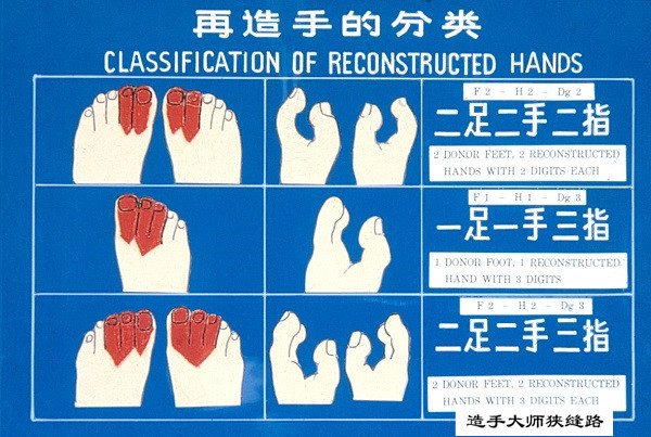 高戈里：医疗行业“三个至上”弊端的典型案例——“再造手”濒临失传的反思